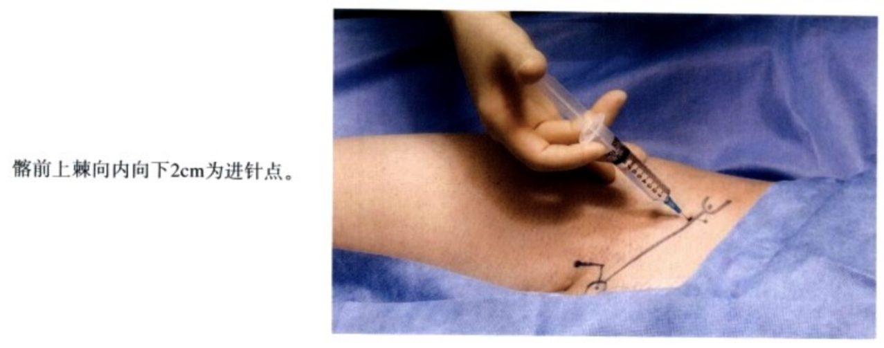 神经刺激仪引导下肢神经阻滞图示 - 第7张