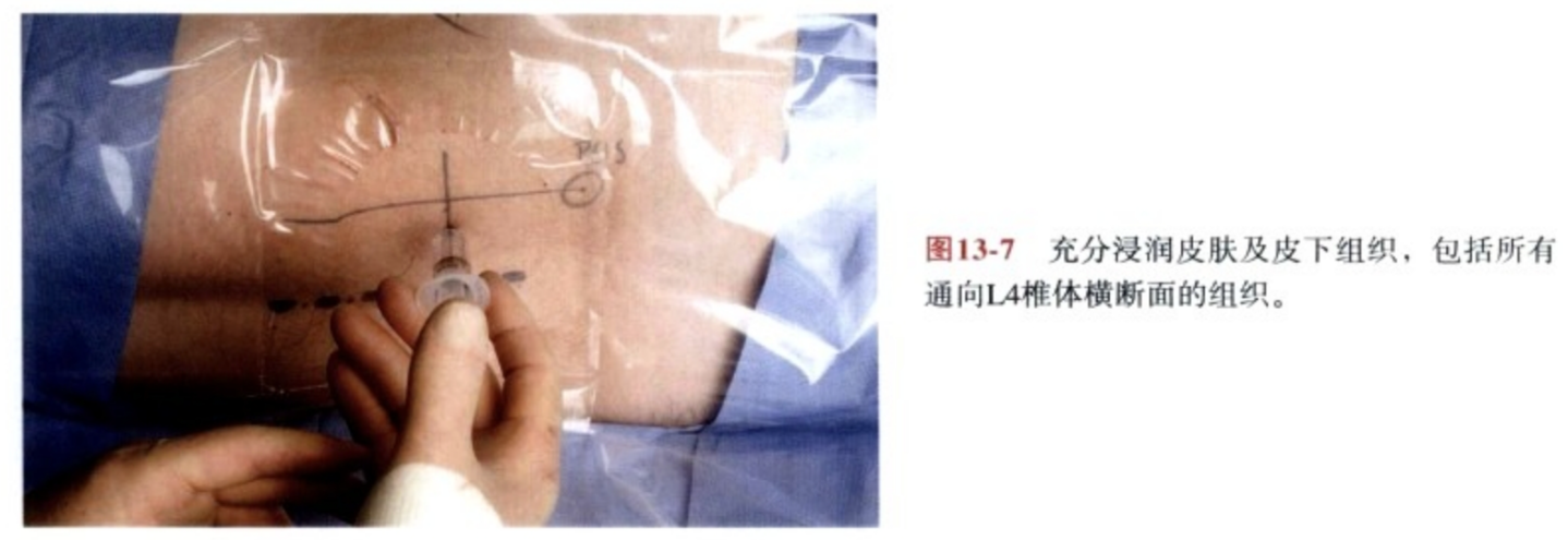 神经刺激仪引导下肢神经阻滞图示 - 第6张