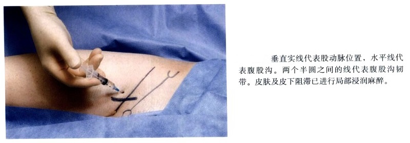 神经刺激仪引导下肢神经阻滞图示 - 第2张