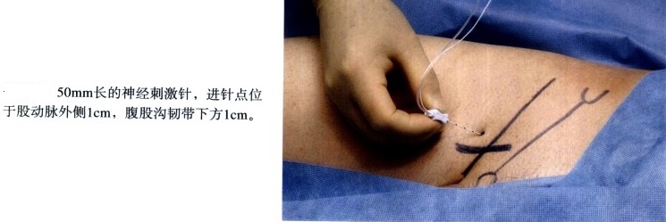 神经刺激仪引导下肢神经阻滞图示 - 第3张