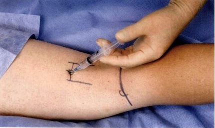 神经刺激仪引导下肢神经阻滞图示 - 第1张