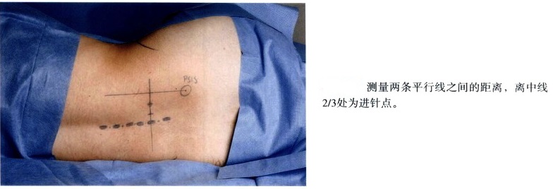 神经刺激仪引导下肢神经阻滞图示 - 第5张