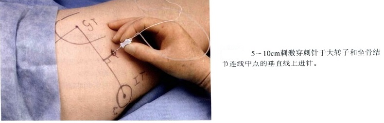 神经刺激仪引导下肢神经阻滞图示 - 第4张