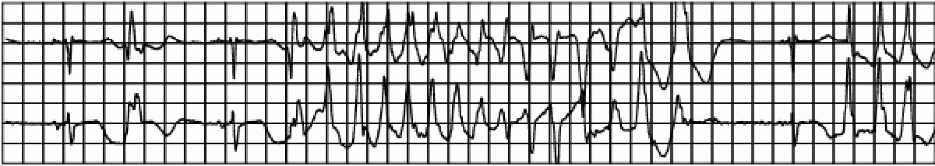 术前ECG:“QT间期延长”！如何警惕诱发尖端扭转型室速？